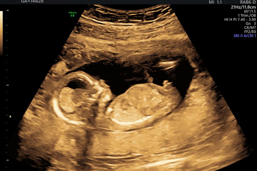 Tidlig scanning i graviditeten